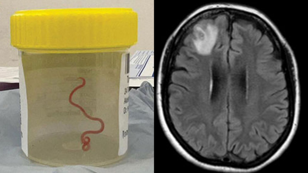 Worms In Spanish Man's Brain Mistaken For Cancer Leaves Doctors Puzzled: Here's What Happened