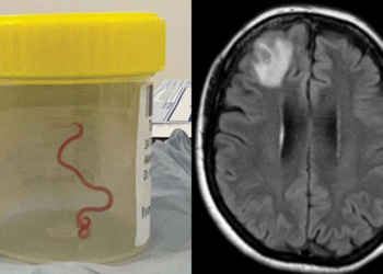 Worms In Spanish Man’s Brain Mistaken For Cancer Leaves Doctors Puzzled: Here’s What Happened