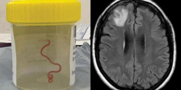 Worms In Spanish Man’s Brain Mistaken For Cancer Leaves Doctors Puzzled: Here’s What Happened