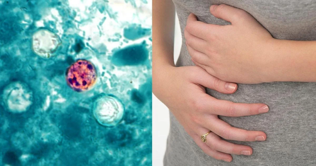 Cyclospora: Explosive Diarrhea Parasite Outbreak Spreads Across the US