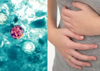Cyclospora: Explosive Diarrhea Parasite Outbreak Spreads Across the US: All About It