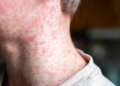 Measles Outbreak in the US Hits Highest Level in Over Three Decades: What’s Driving the Surge?