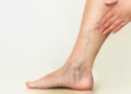 Varicose Veins Are No Longer Just a Cosmetic Concern: Why More People Are Seeking Treatment
