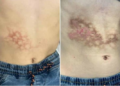 Erythema Ab Igne