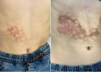 Erythema Ab Igne