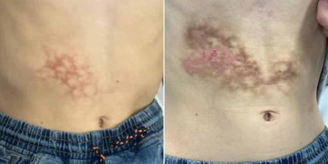 Erythema Ab Igne