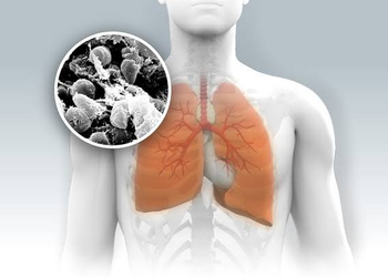 Understanding Pneumonic Plague: What Is It, and How Dangerous Is the Infection?