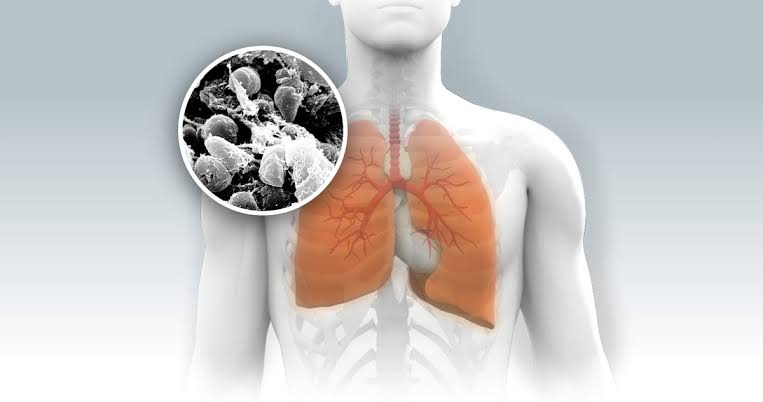 Understanding Pneumonic Plague: What Is It, How Dangerous Is The Infection?