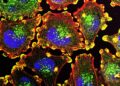 Fluorescence microscope image of melanoma cells with blue nuclei, red actin filaments and yellow podosome structures