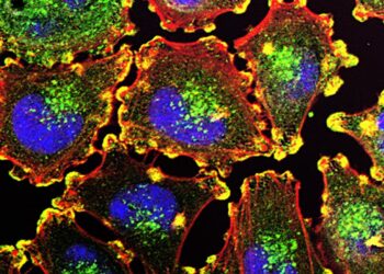 Fluorescence microscope image of melanoma cells with blue nuclei, red actin filaments and yellow podosome structures