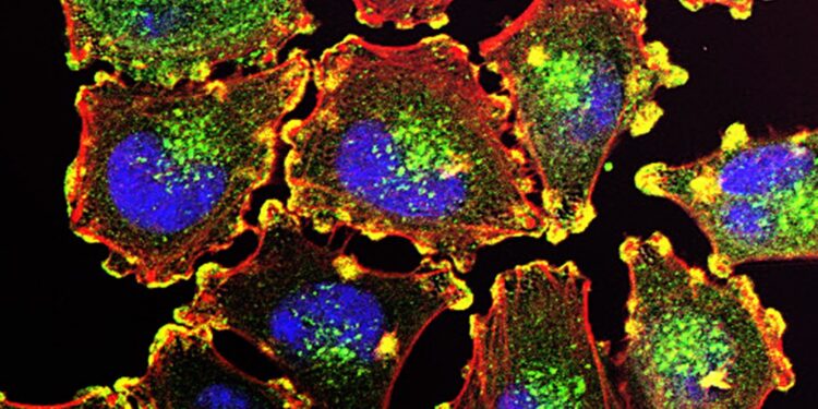 Fluorescence microscope image of melanoma cells with blue nuclei, red actin filaments and yellow podosome structures