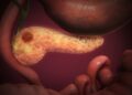 3D medical illustration of a pancreas with a dark tumor lump near its head, beside the stomach and small intestine