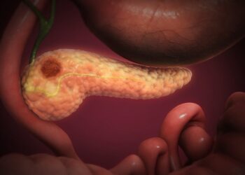 3D medical illustration of a pancreas with a dark tumor lump near its head, beside the stomach and small intestine