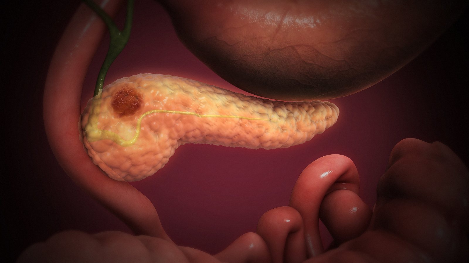 3D medical illustration of a pancreas with a dark tumor lump near its head, beside the stomach and small intestine